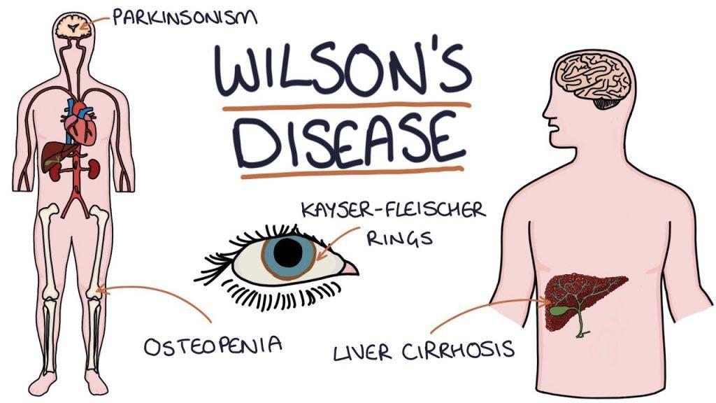 विल्सन रोग क्या है और ये कैसे होता है ?